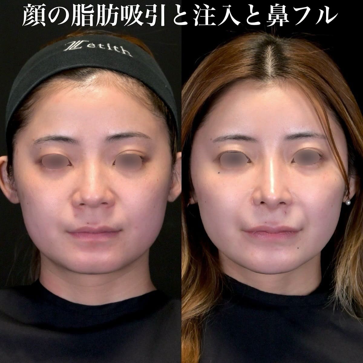 鉄医師による鼻整形の術前/術後6ヶ月