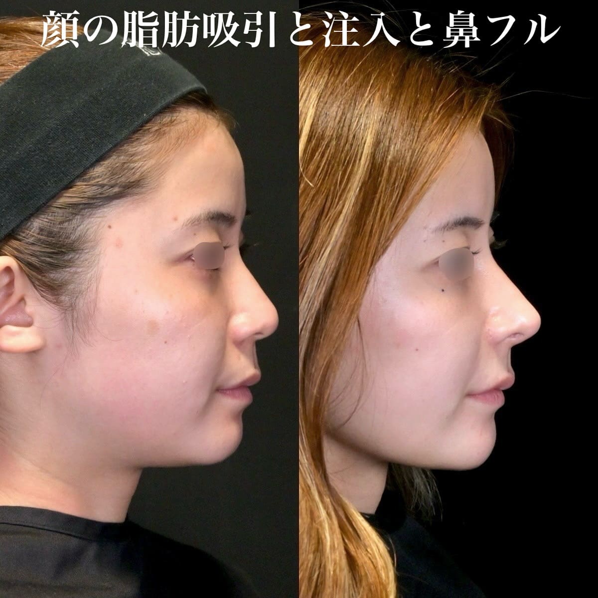 鉄医師による鼻整形の術前/術後6ヶ月 Дараа 