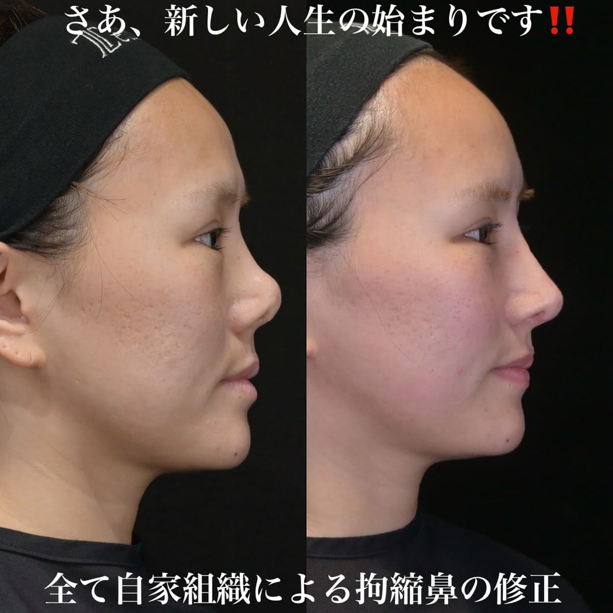 鉄医師による鼻整形の術前/術後3ヶ月 หลัง 
