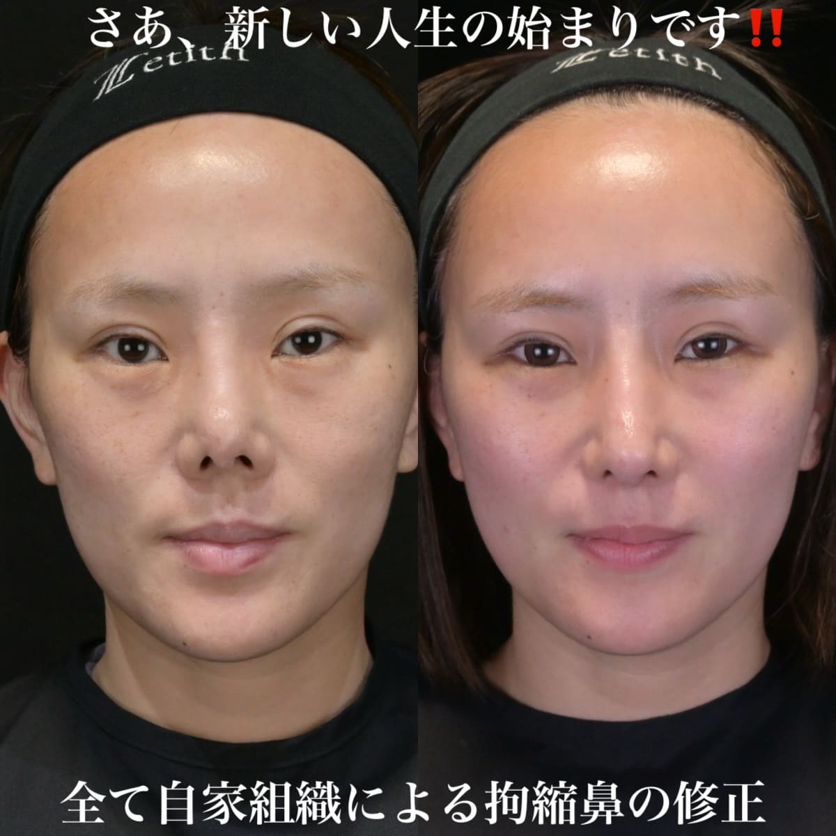 鉄医師による鼻整形の術前/術後3ヶ月