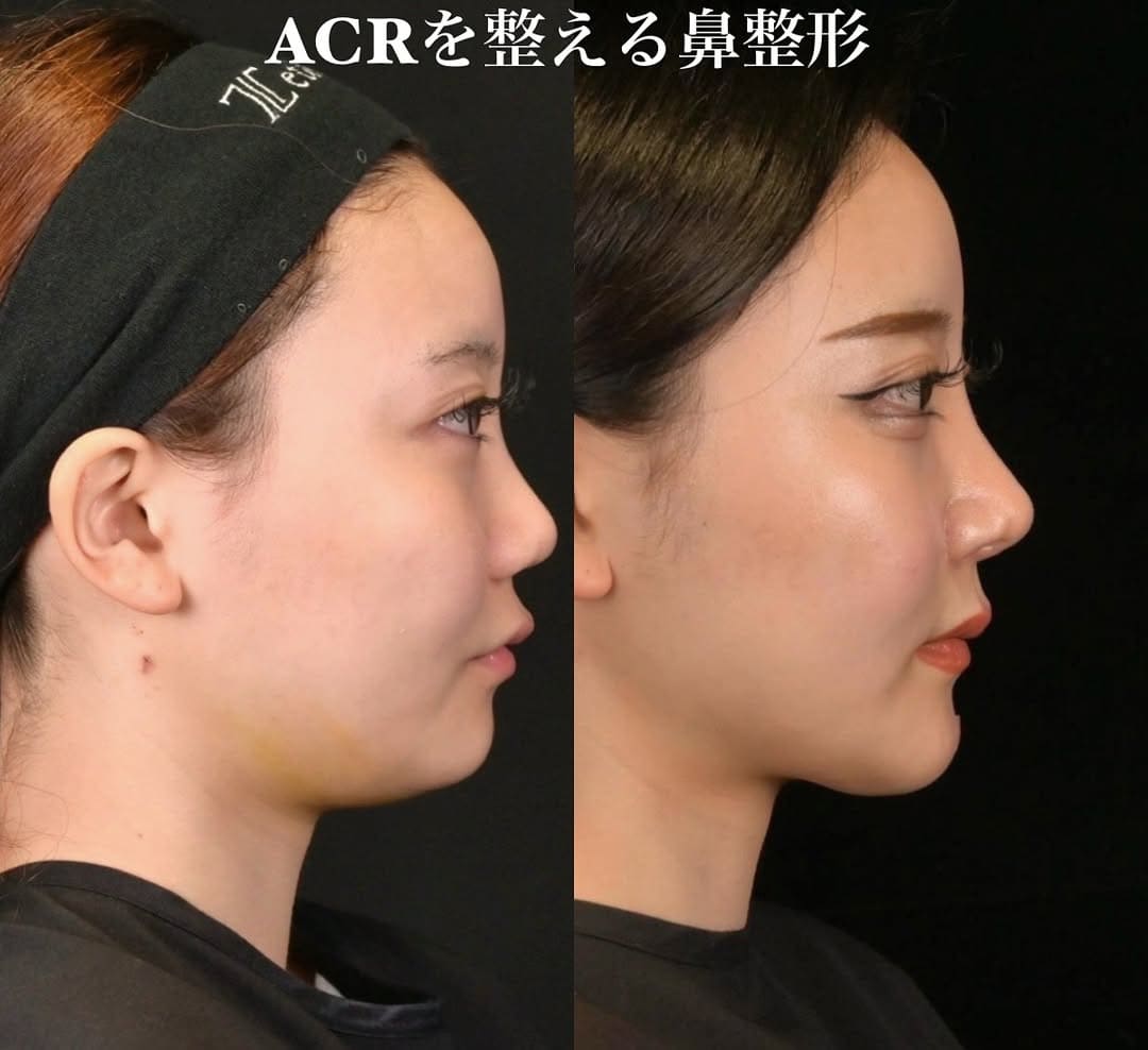 鉄医師による鼻整形の術前/術後6ヶ月 หลัง 