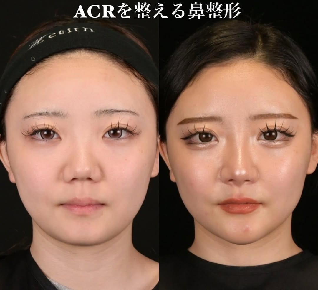 鉄医師による鼻整形の術前/術後6ヶ月