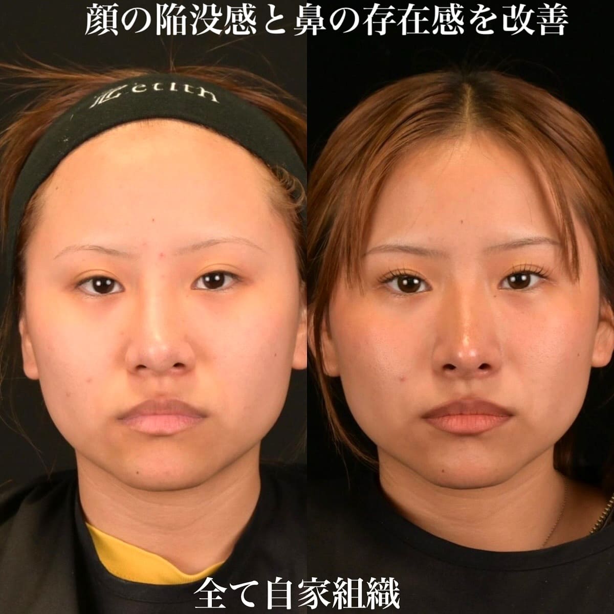 鉄医師による鼻整形の術前/術後6ヶ月