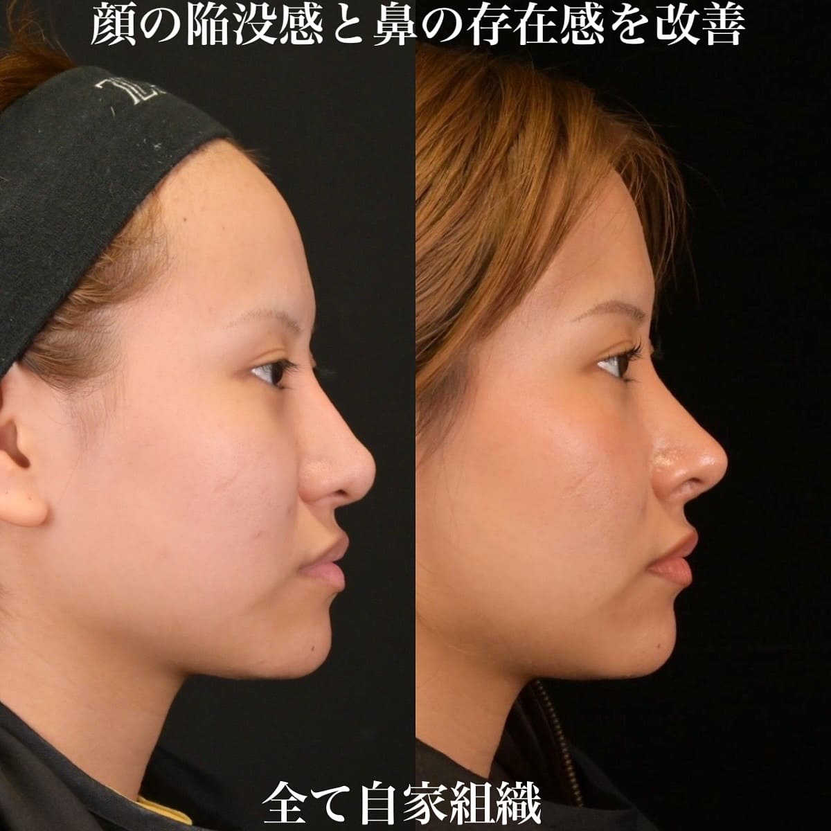 鉄医師による鼻整形の術前/術後6ヶ月 After 