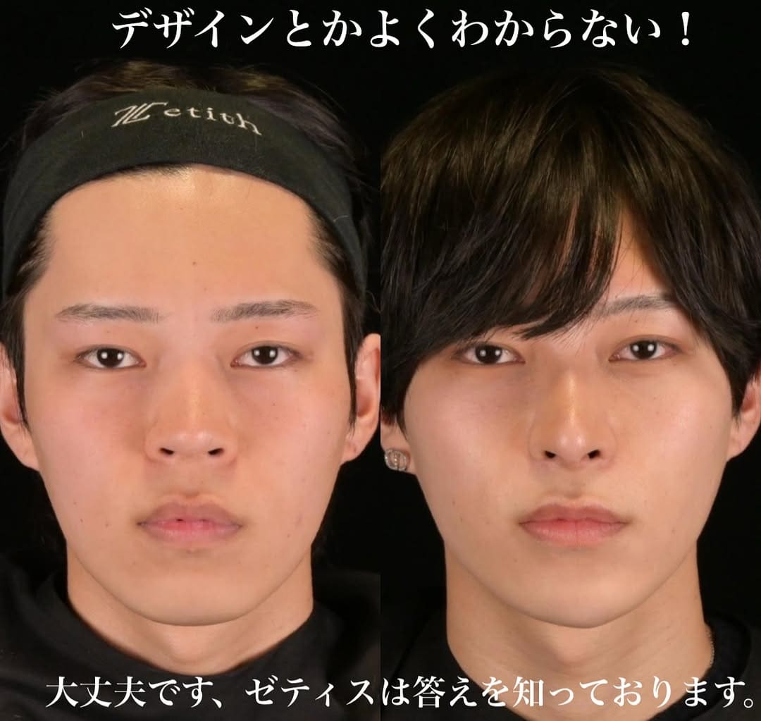 鉄医師による鼻整形の術前/術後6ヶ月