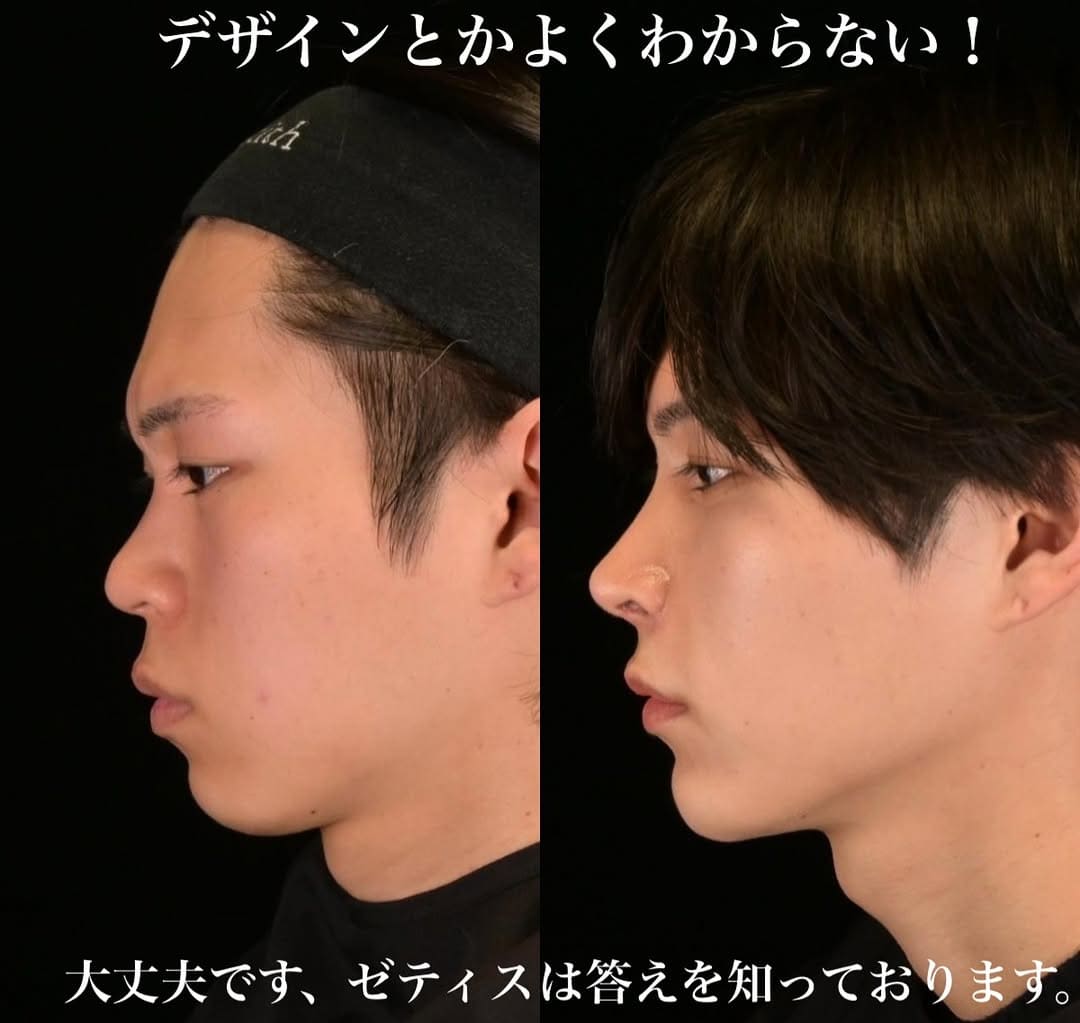 鉄医師による鼻整形の術前/術後6ヶ月 施術後 