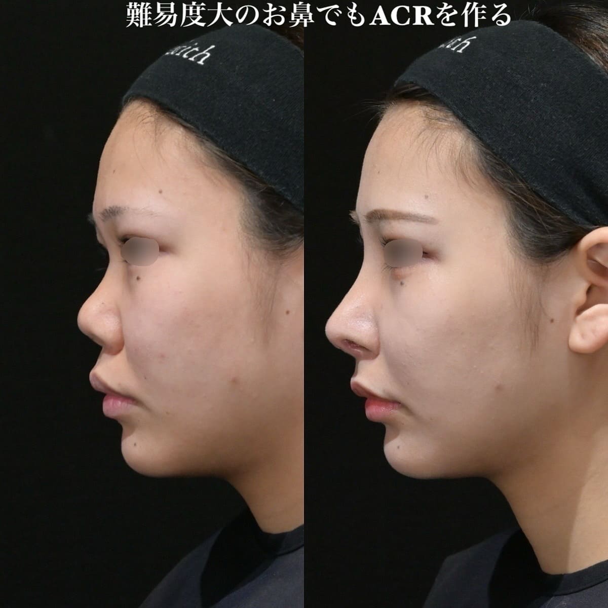 鉄医師による鼻整形の術前/術後1ヶ月 术后 