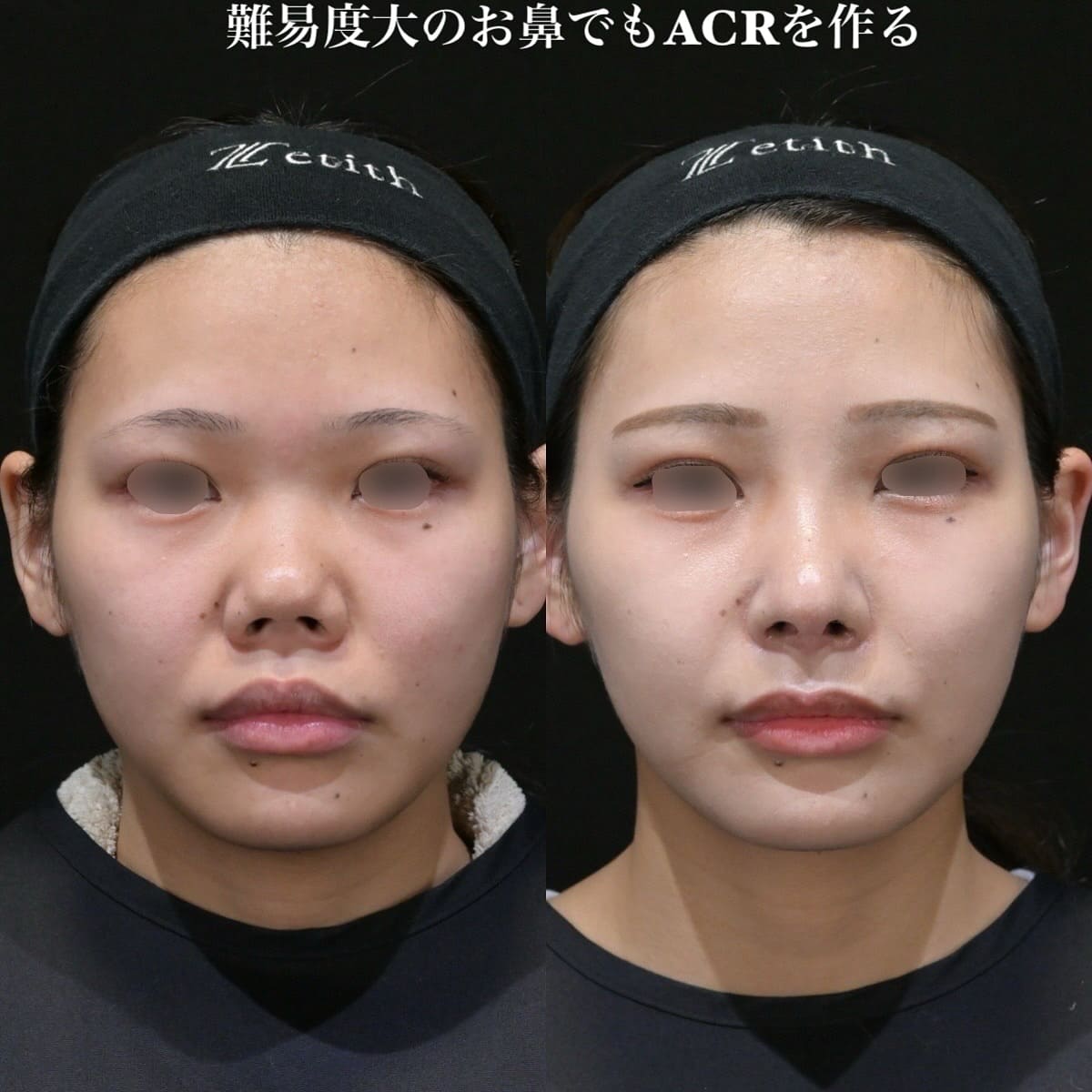 鉄医師による鼻整形の術前/術後1ヶ月