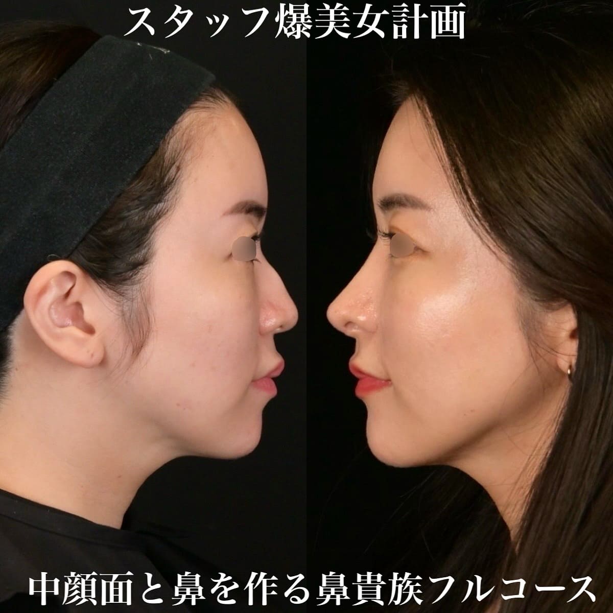 鉄医師による鼻整形の術前/術後6ヶ月 术后 