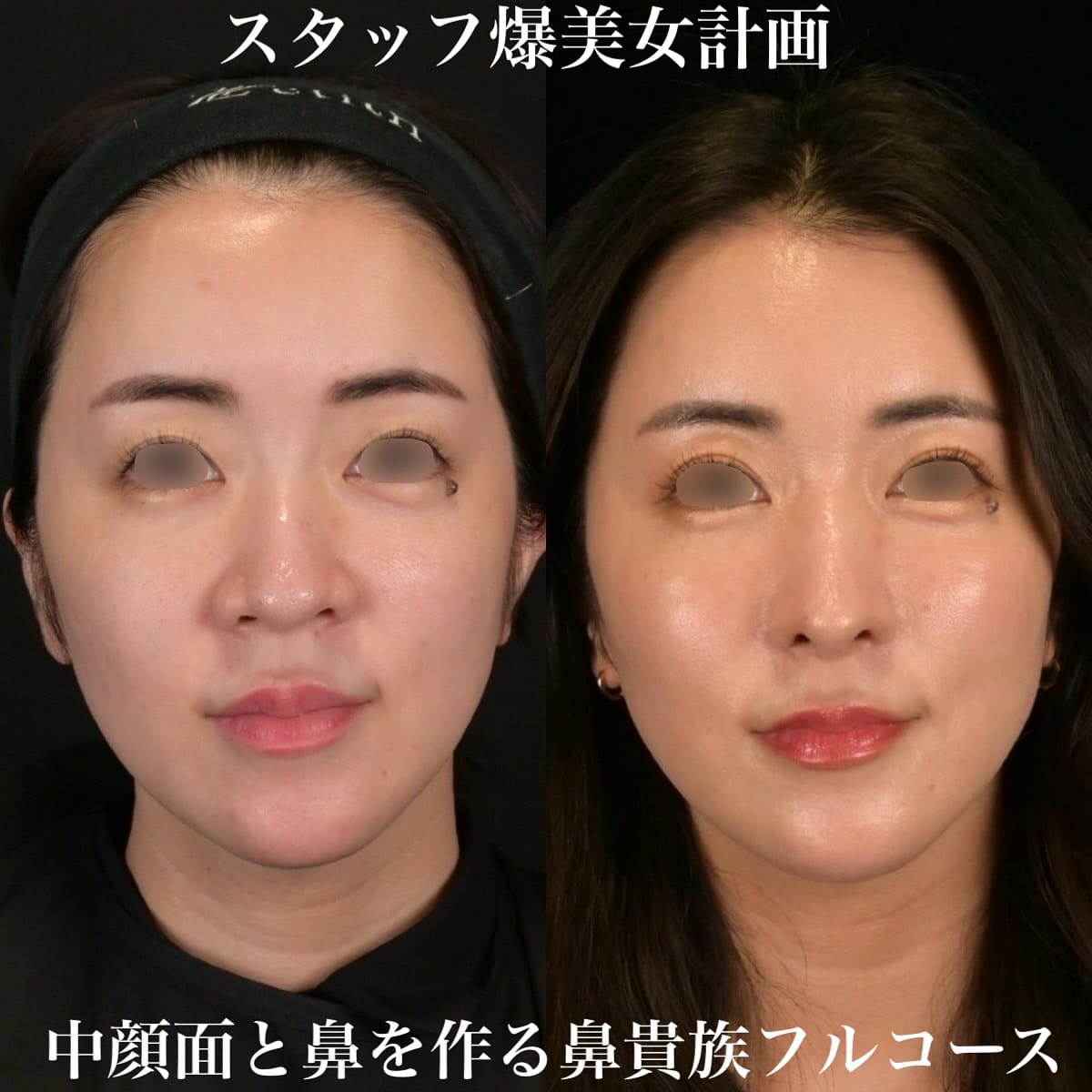 鉄医師による鼻整形の術前/術後6ヶ月