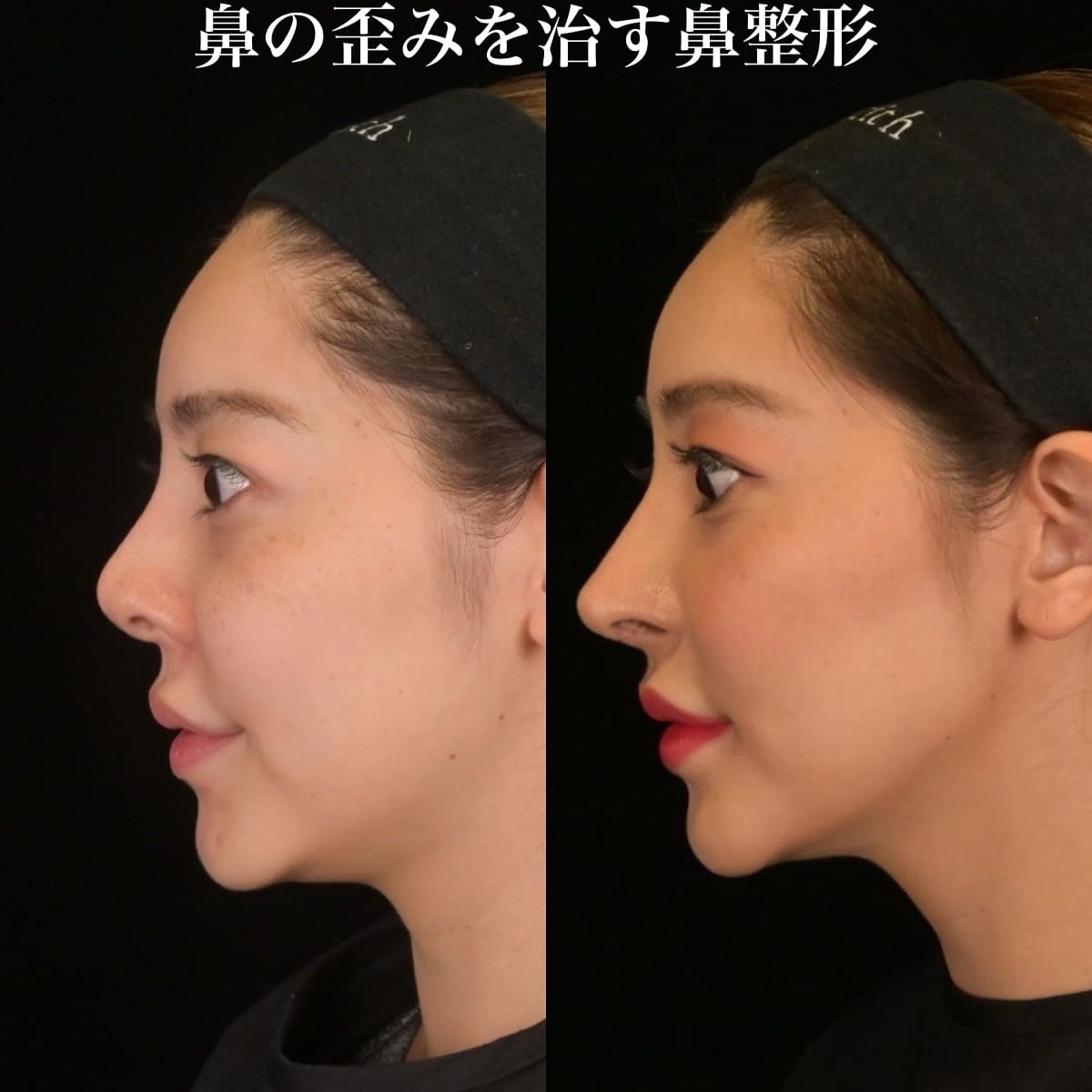 鉄医師による鼻整形の術前/術後1ヶ月 หลัง 