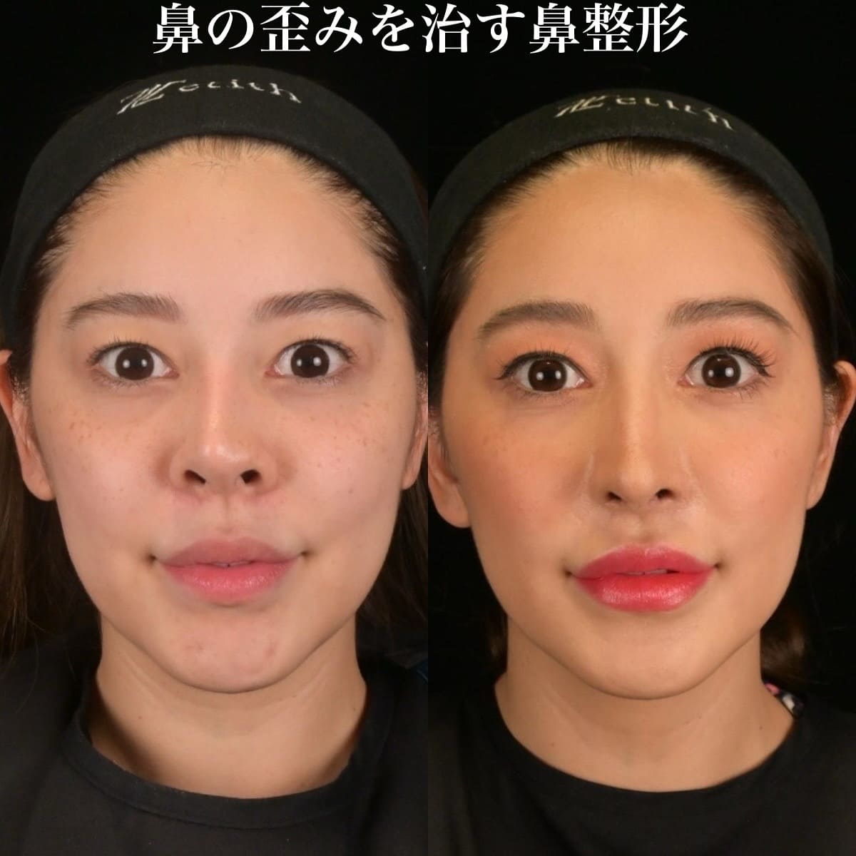鉄医師による鼻整形の術前/術後1ヶ月