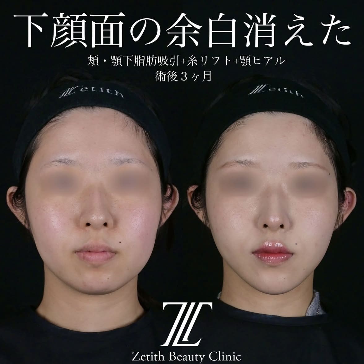 北村医師による脂肪吸引リフトの術前/術後3ヶ月