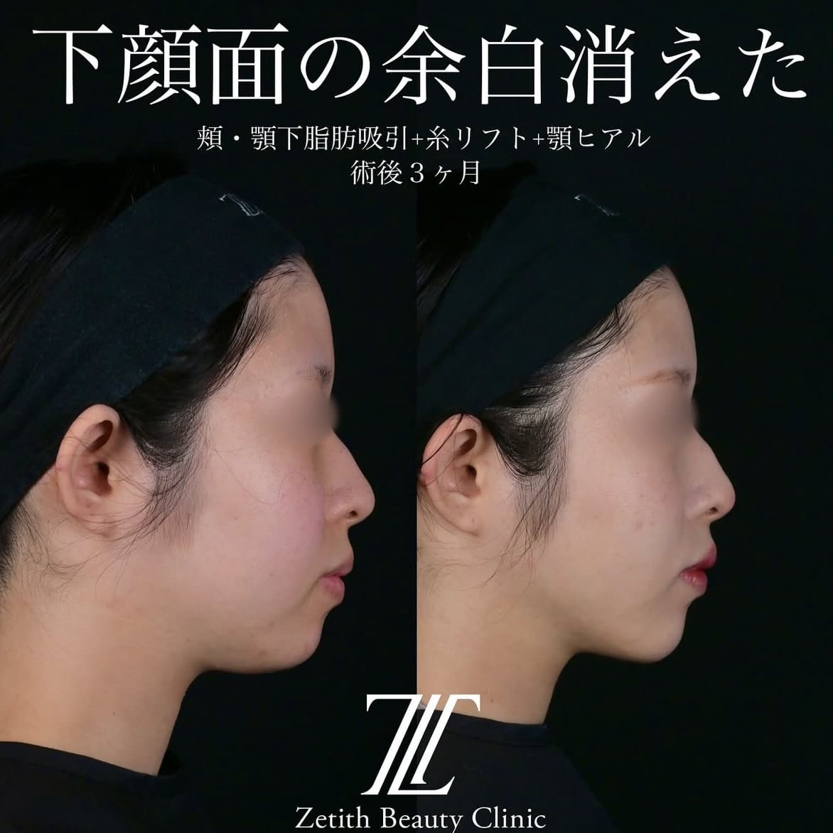 北村医師による脂肪吸引リフトの術前/術後3ヶ月 After 