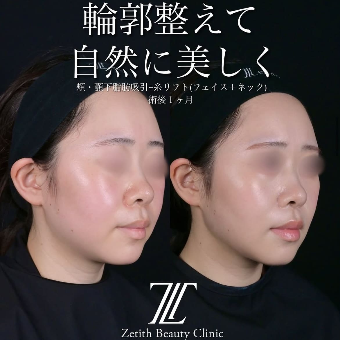北村医師による脂肪吸引リフトの術前/術後1ヶ月後