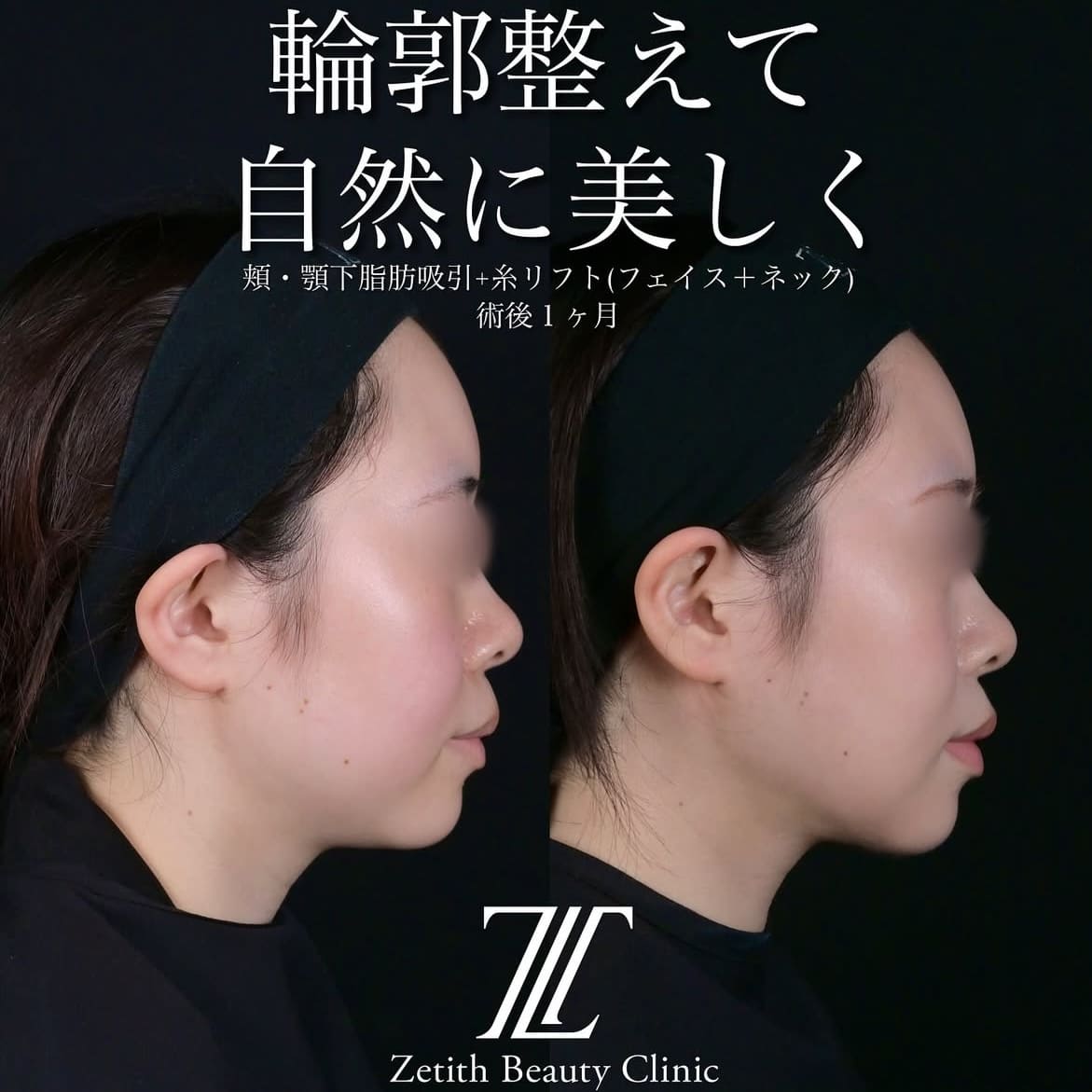 北村医師による脂肪吸引リフトの術前/術後1ヶ月後 施術後 