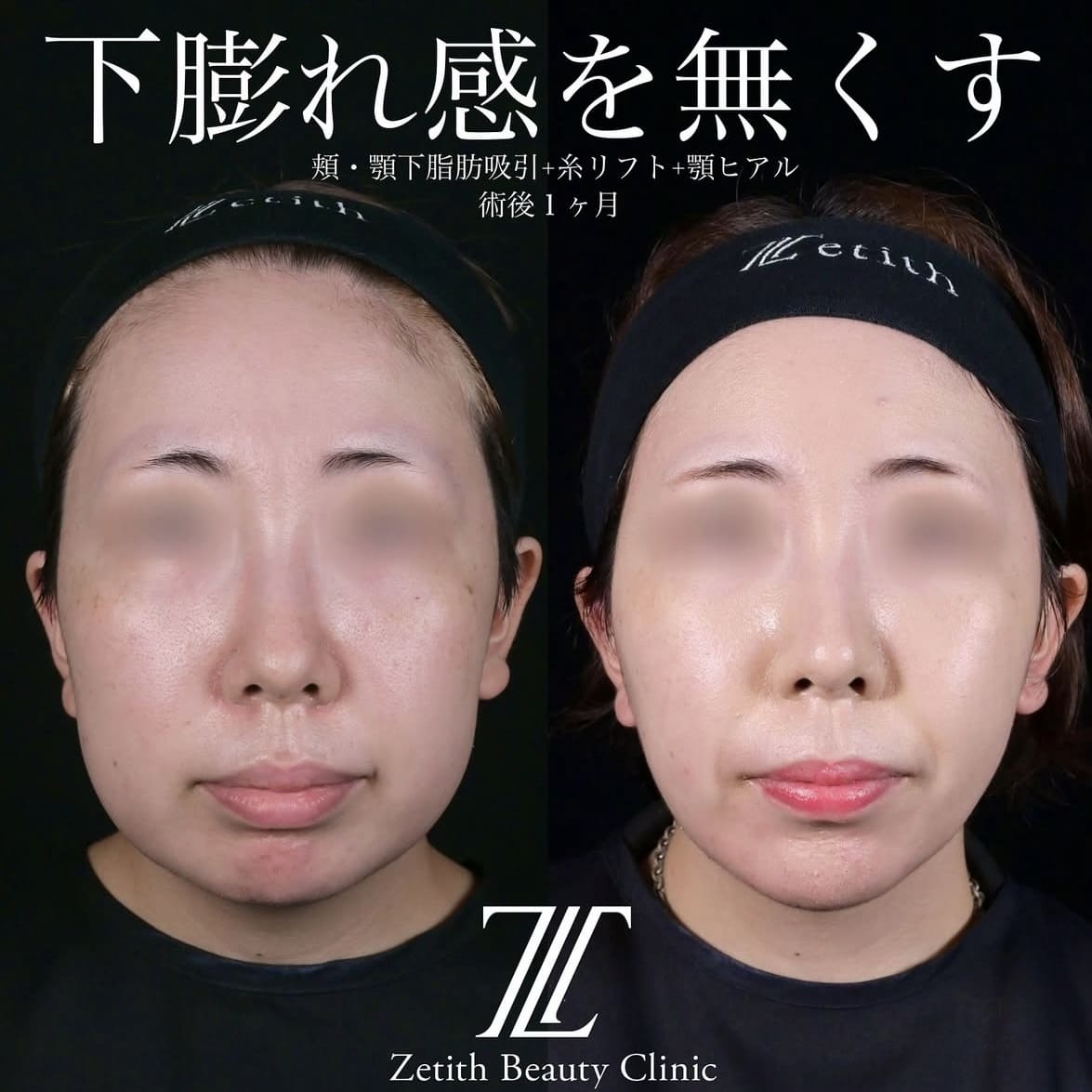 北村医師による脂肪吸引リフトの術前/術後1ヶ月