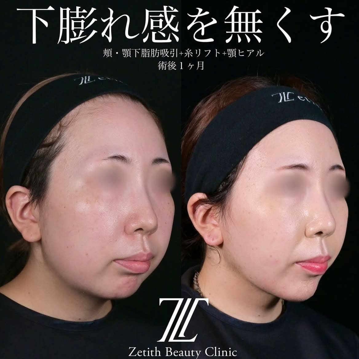 北村医師による脂肪吸引リフトの術前/術後1ヶ月 หลัง 