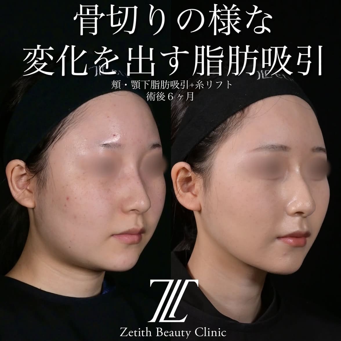 北村医師による脂肪吸引リフトの術前/術後6ヶ月