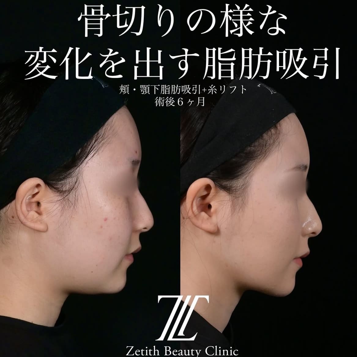 北村医師による脂肪吸引リフトの術前/術後6ヶ月 After 