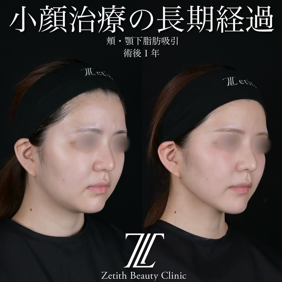 北村医師による脂肪吸引リフトの術前/術後1年