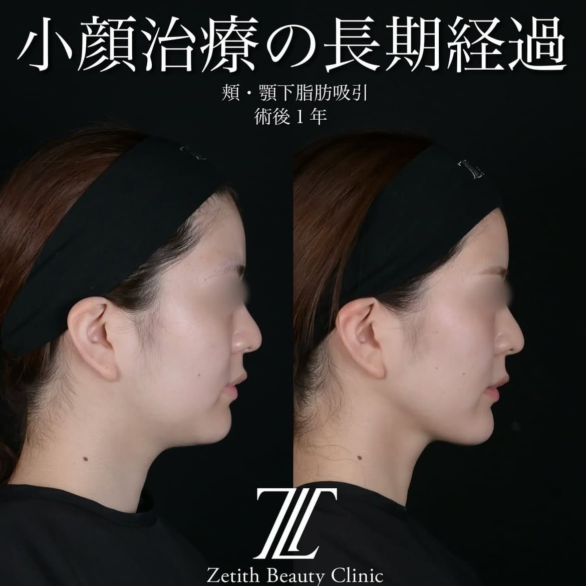 北村医師による脂肪吸引リフトの術前/術後1年 施術後 
