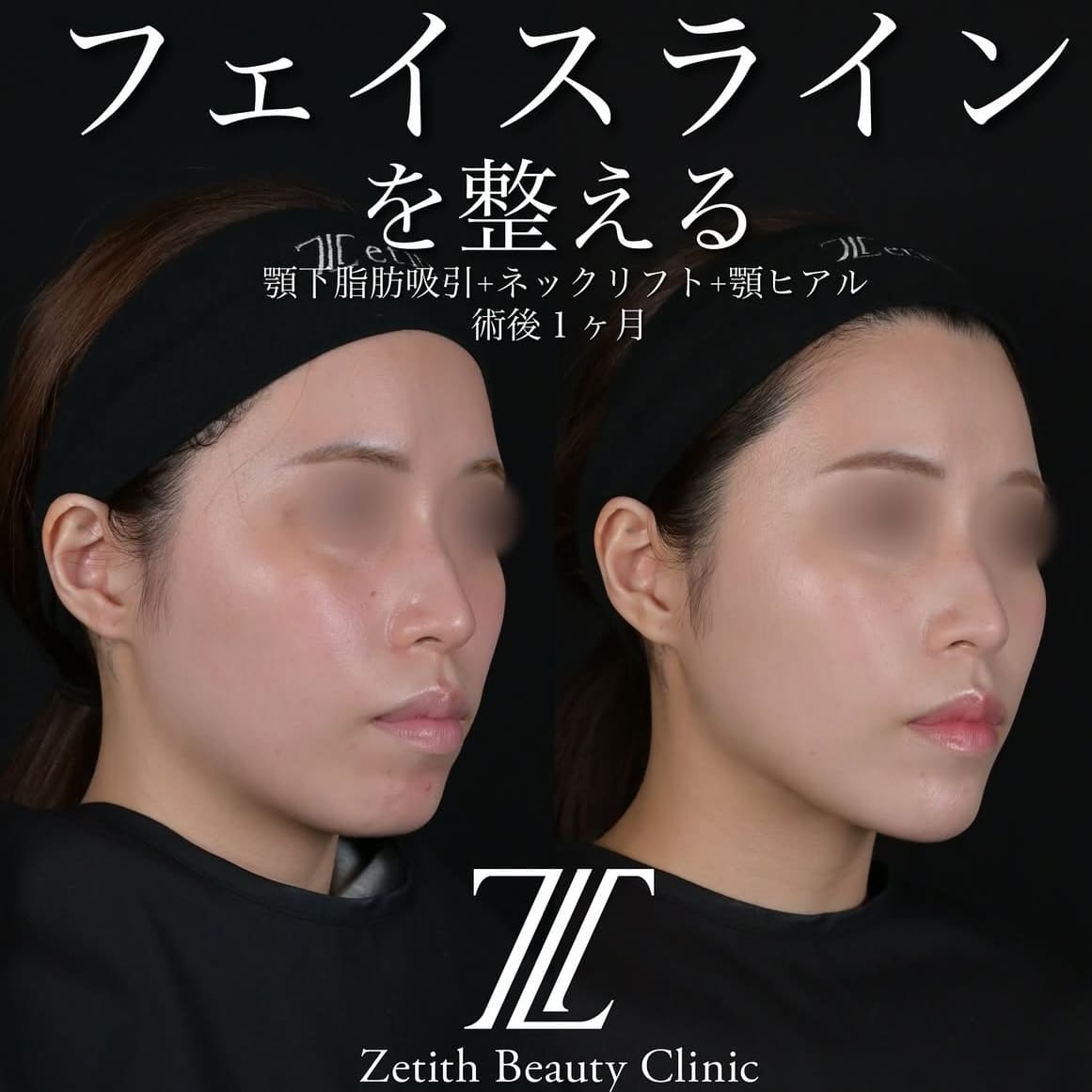 北村医師による脂肪吸引リフトの術前/術後1ヶ月