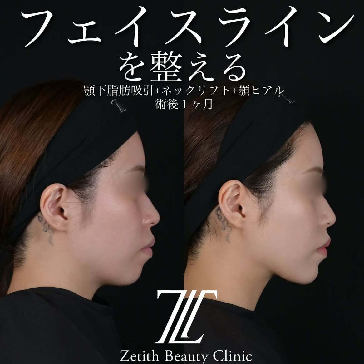 北村医師による脂肪吸引リフトの術前/術後1ヶ月 施術後 
