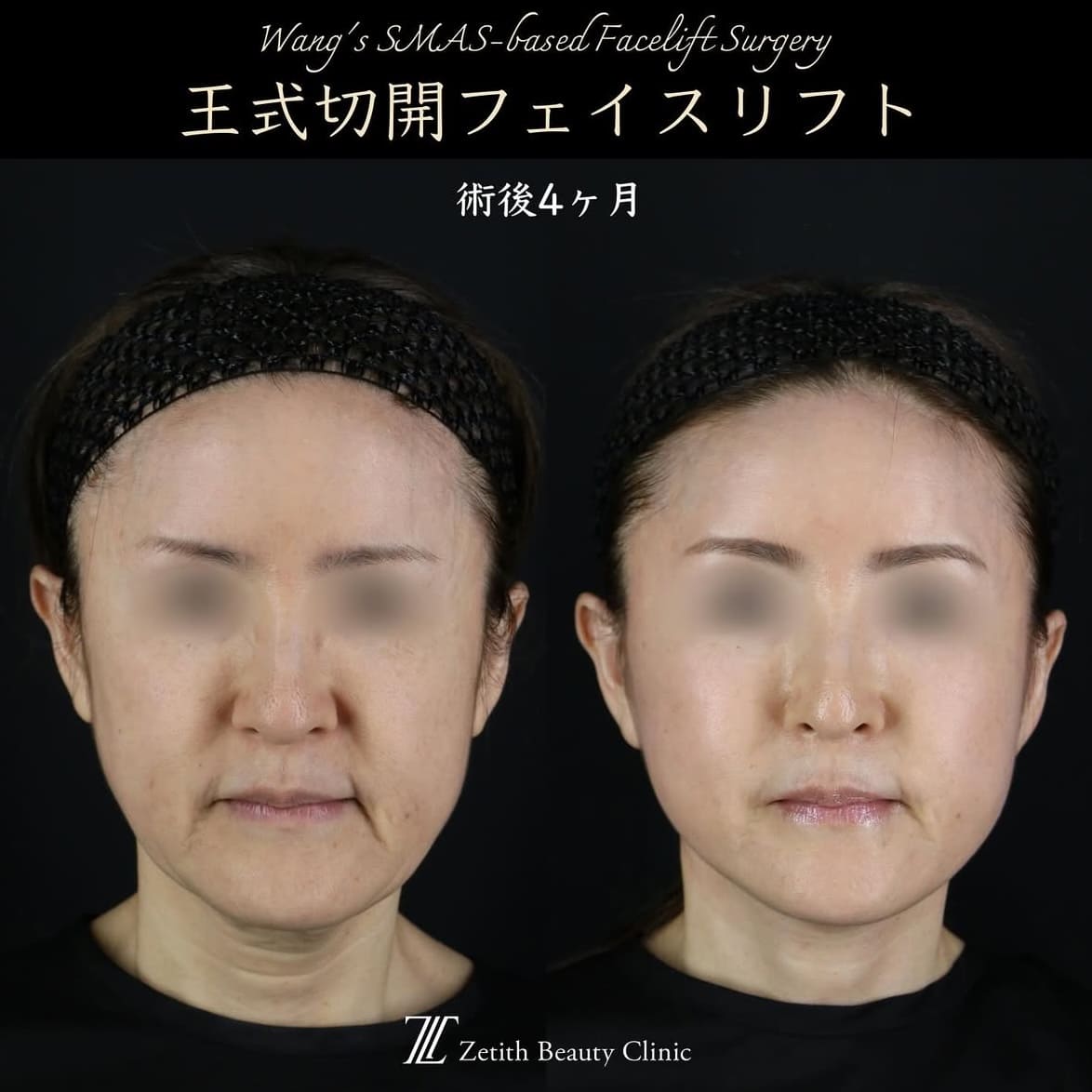 王医師による切開リフトの術前/術後4ヶ月