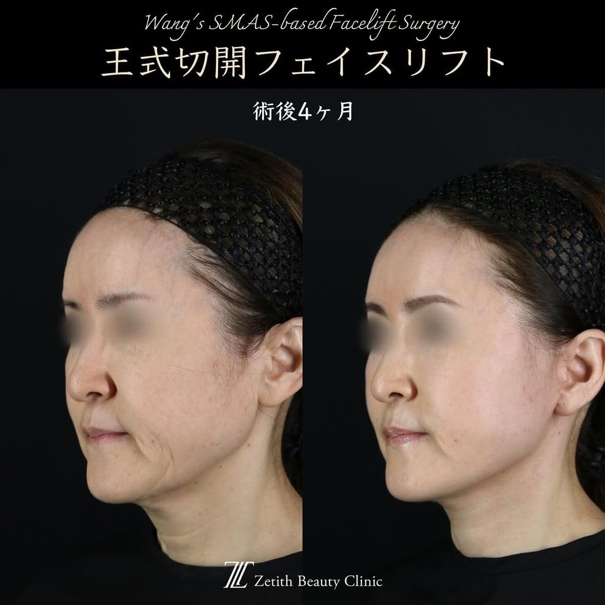 王医師による切開リフトの術前/術後4ヶ月 After 