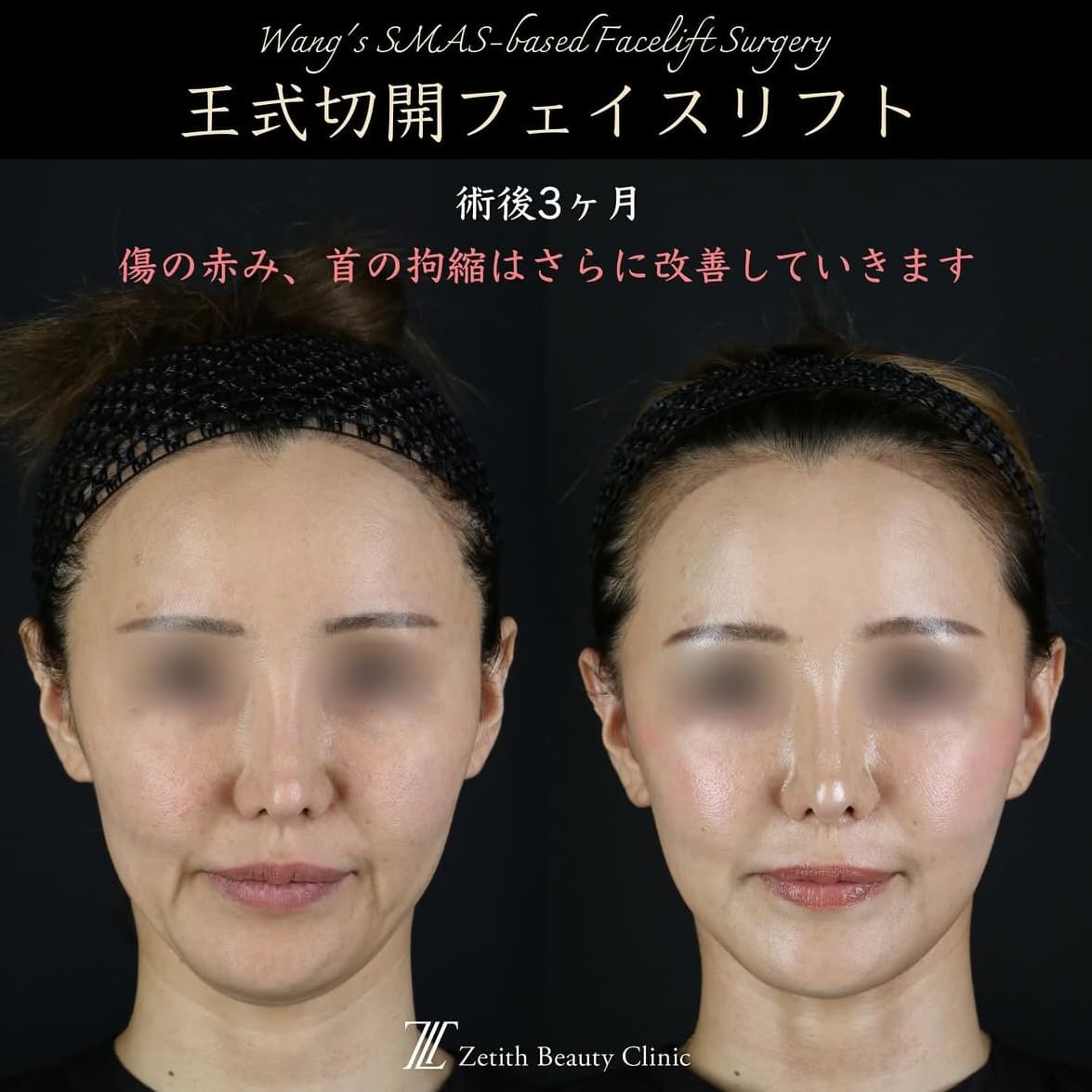 王医師による切開リフトの術前/術後3ヶ月