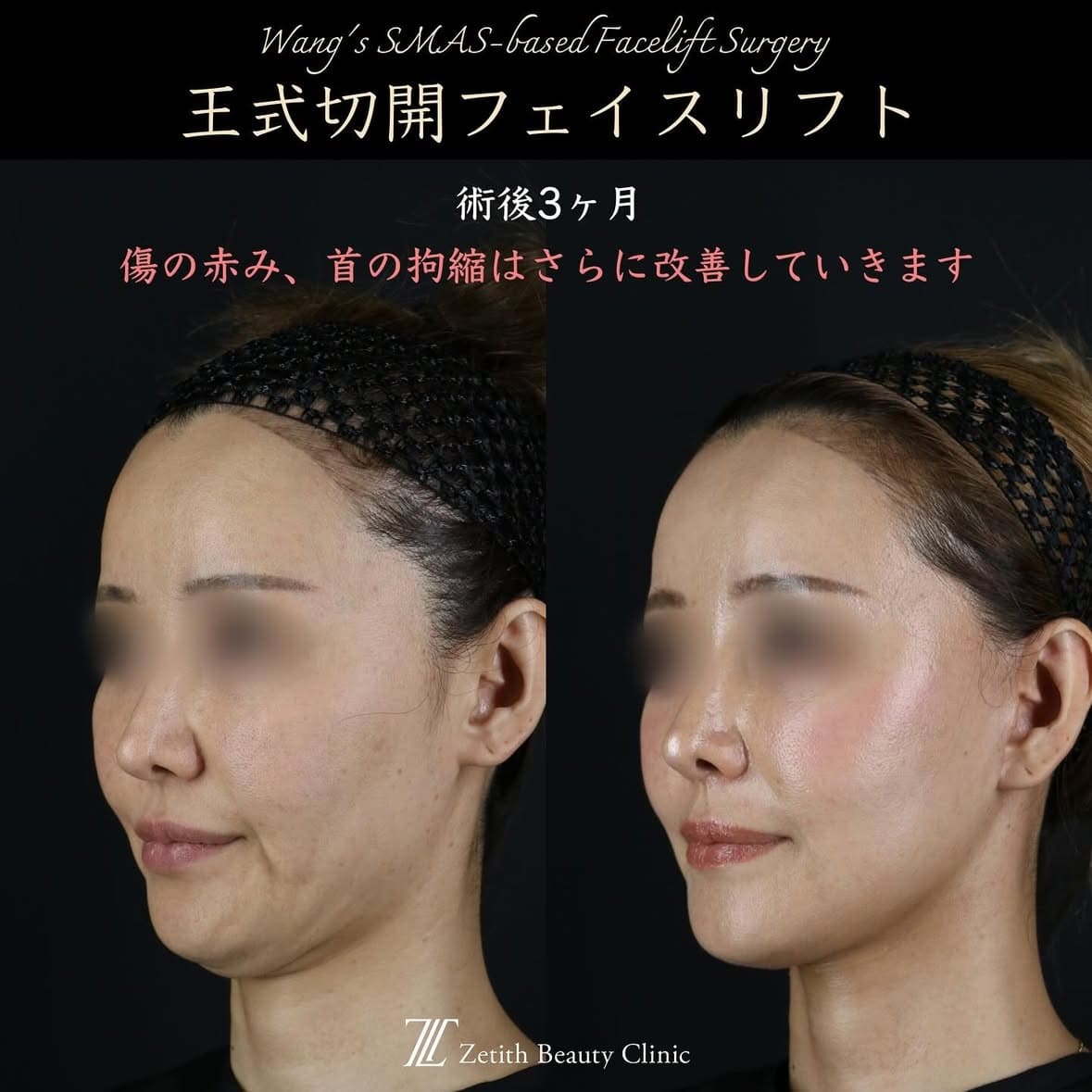 王医師による切開リフトの術前/術後3ヶ月 施術後 