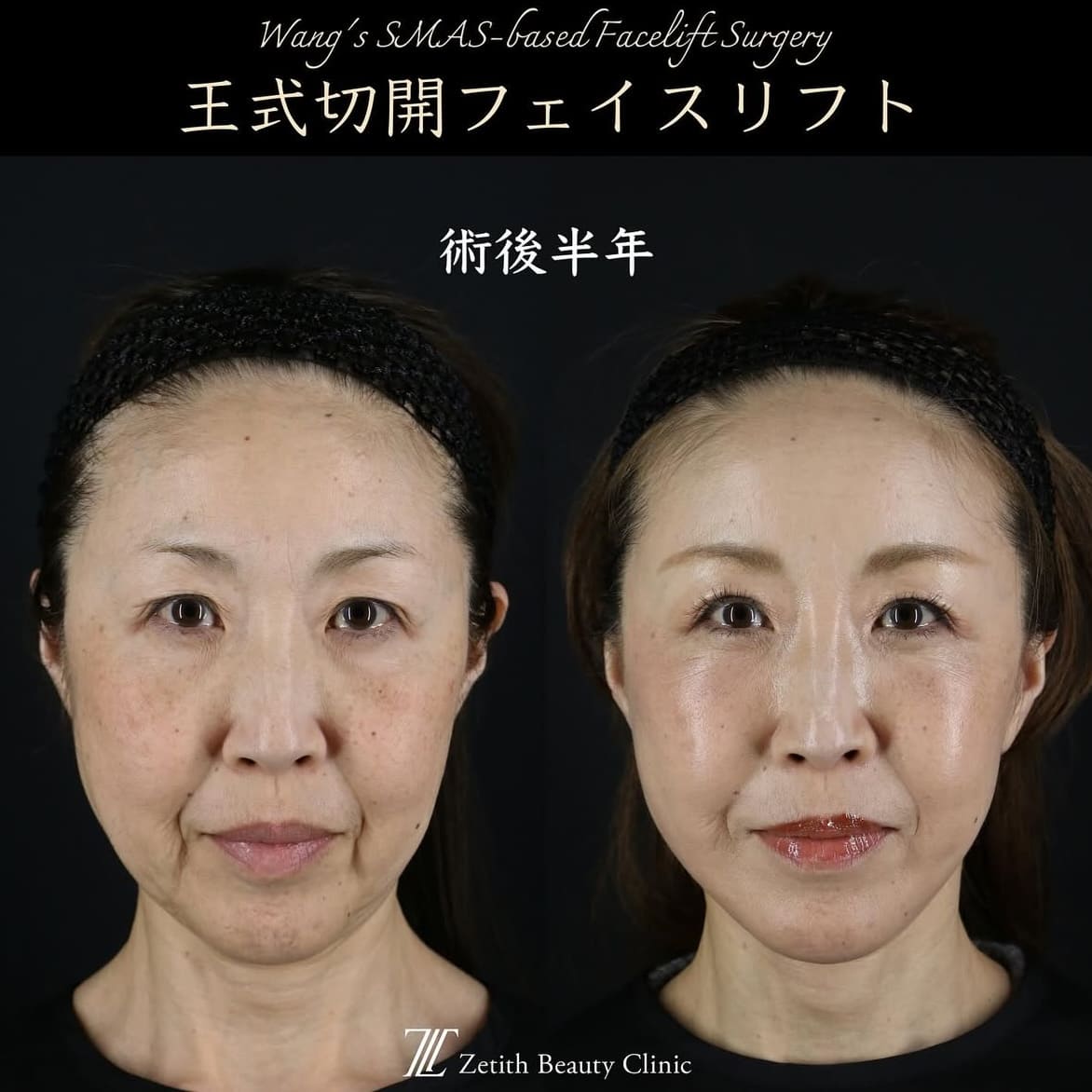 王医師による切開リフトの術前/術後半年
