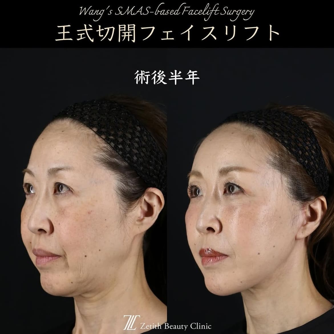 王医師による切開リフトの術前/術後半年 施術後 