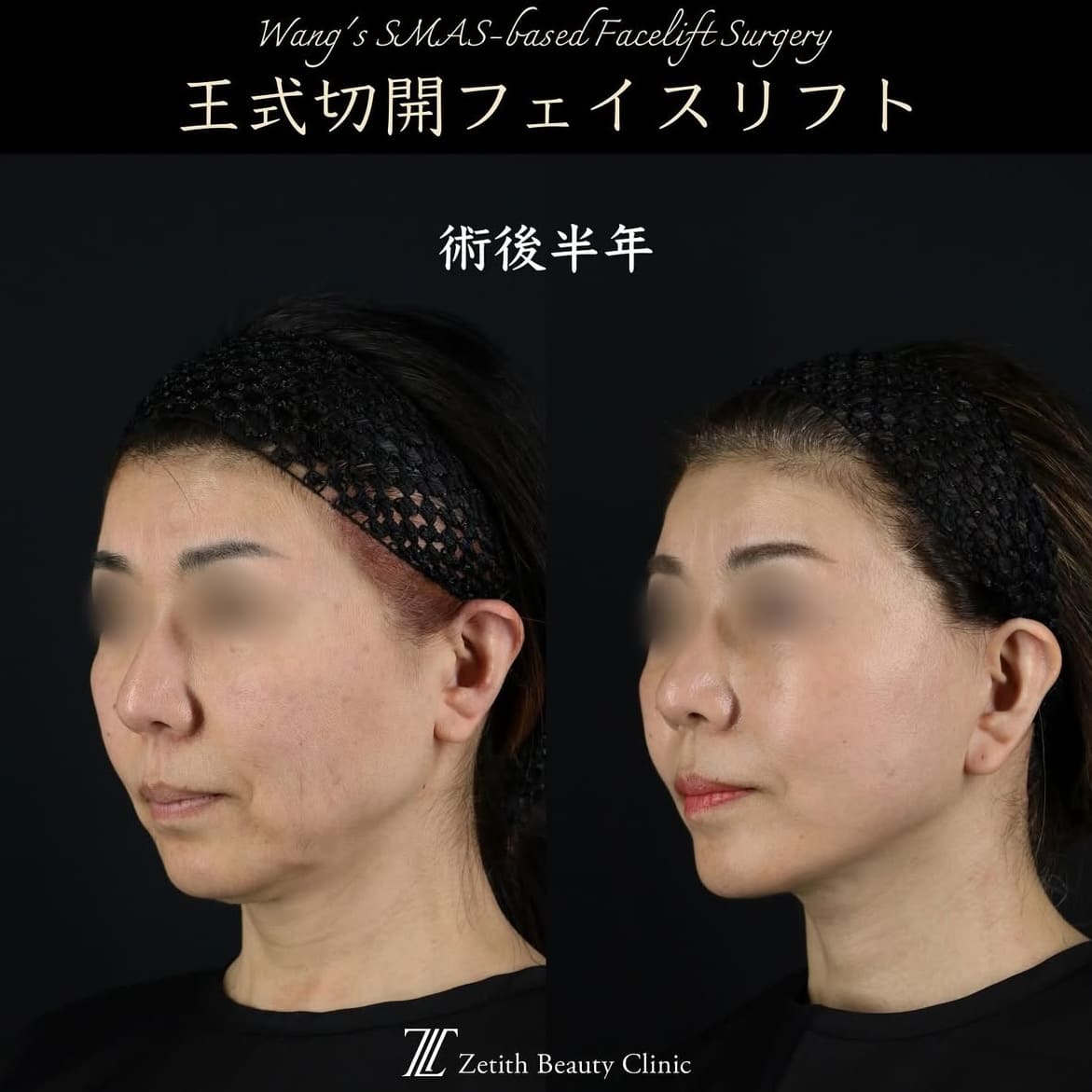 王医師による切開リフトの術前/術後半年