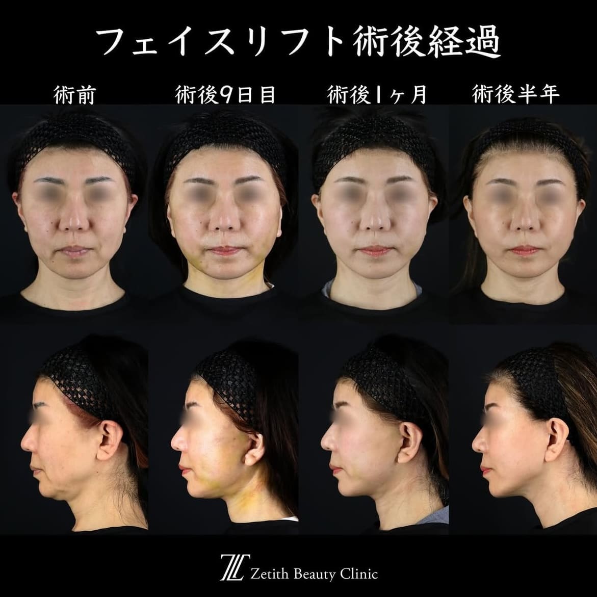 王医師による切開リフトの術前/術後半年 Sonra 