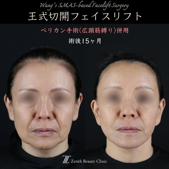 王医師による切開リフトの術前/術後15ヶ月