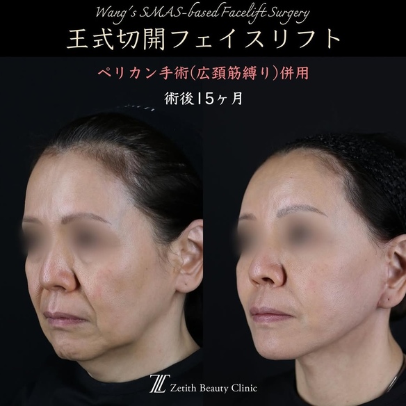 王医師による切開リフトの術前/術後15ヶ月 بعد 