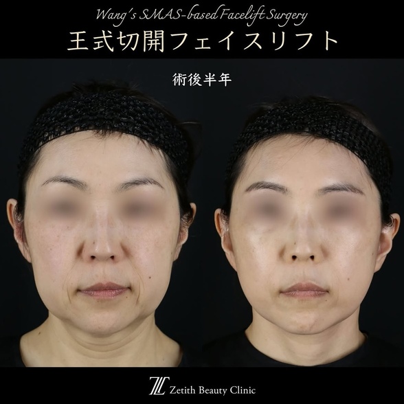 王医師による切開リフトの術前/術後半年