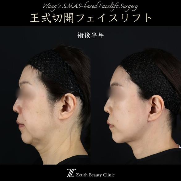 王医師による切開リフトの術前/術後半年 Дараа 