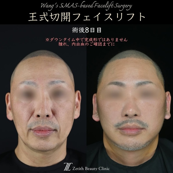 王医師による切開リフトの術前/術後8日
