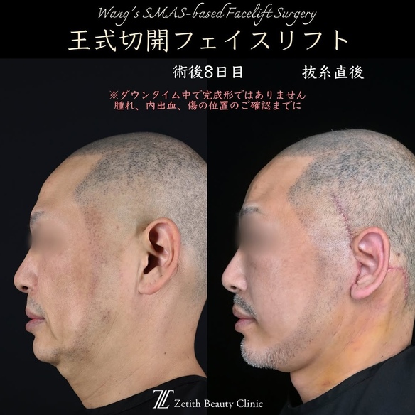 王医師による切開リフトの術前/術後8日 بعد 