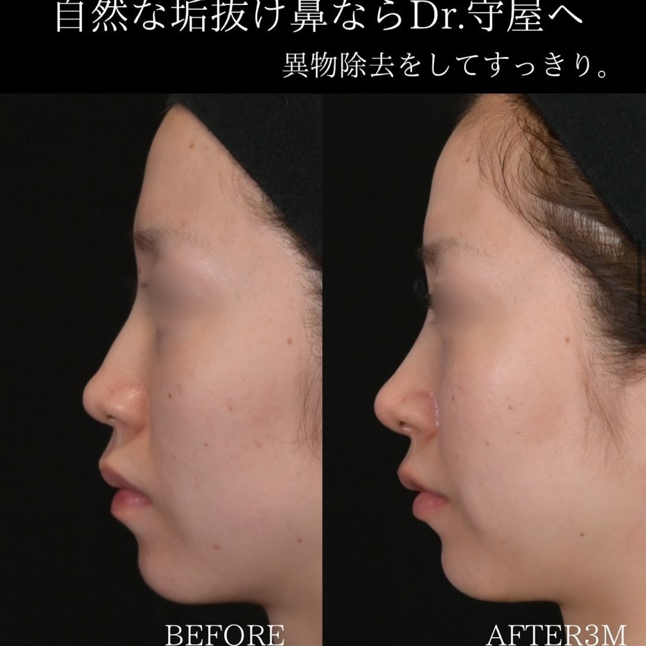 守屋医師による鼻整形の術前/術後3ヶ月 术后 