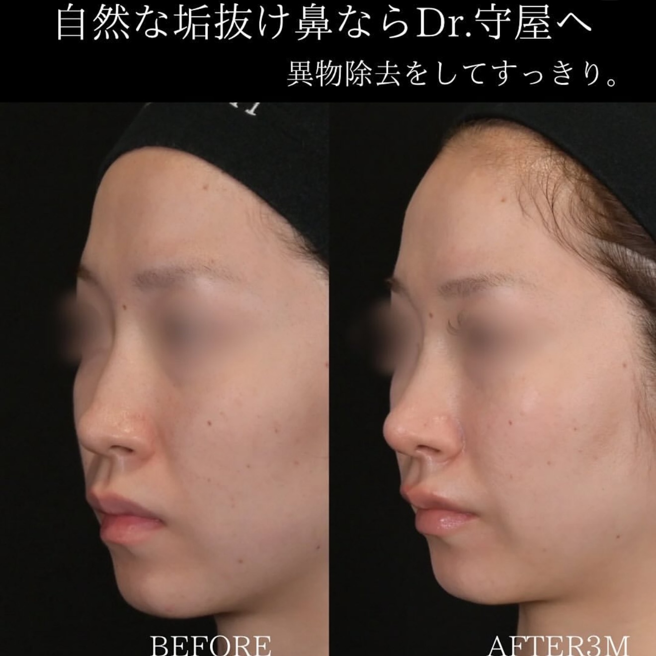 守屋医師による鼻整形の術前/術後3ヶ月