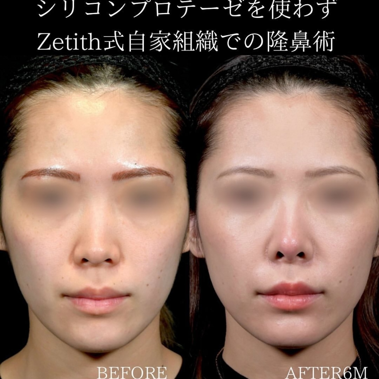 守屋医師による鼻整形の術前/術後6ヶ月