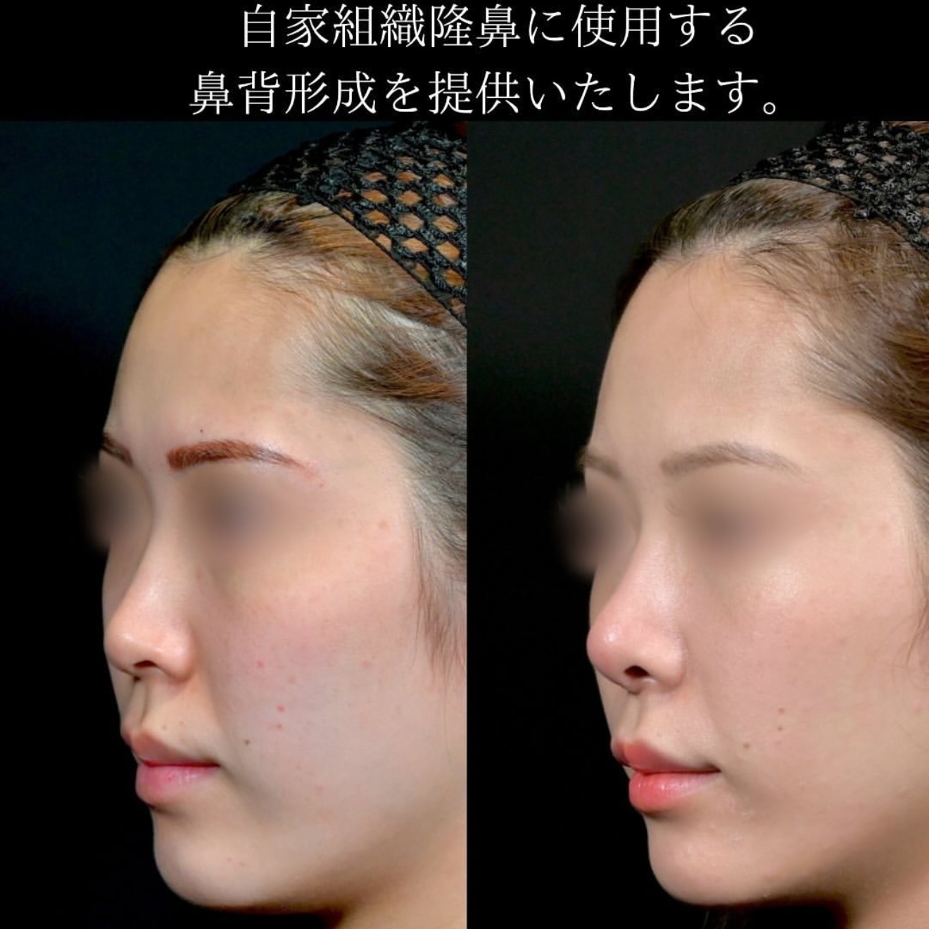 守屋医師による鼻整形の術前/術後6ヶ月 施術後 