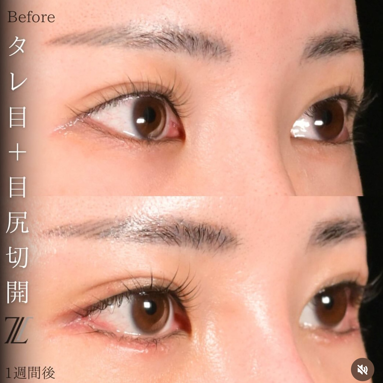 楠本医師による目元形成の術前/術後1週間 施術後 