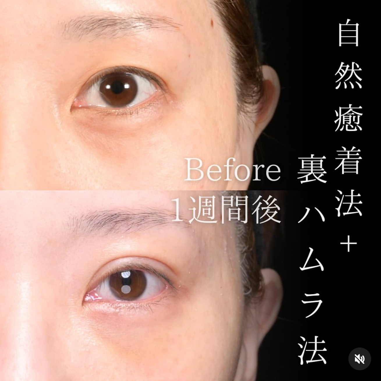 楠本医師による裏ハムラ、埋没法(自然癒着)の術前/術後1週間 After 