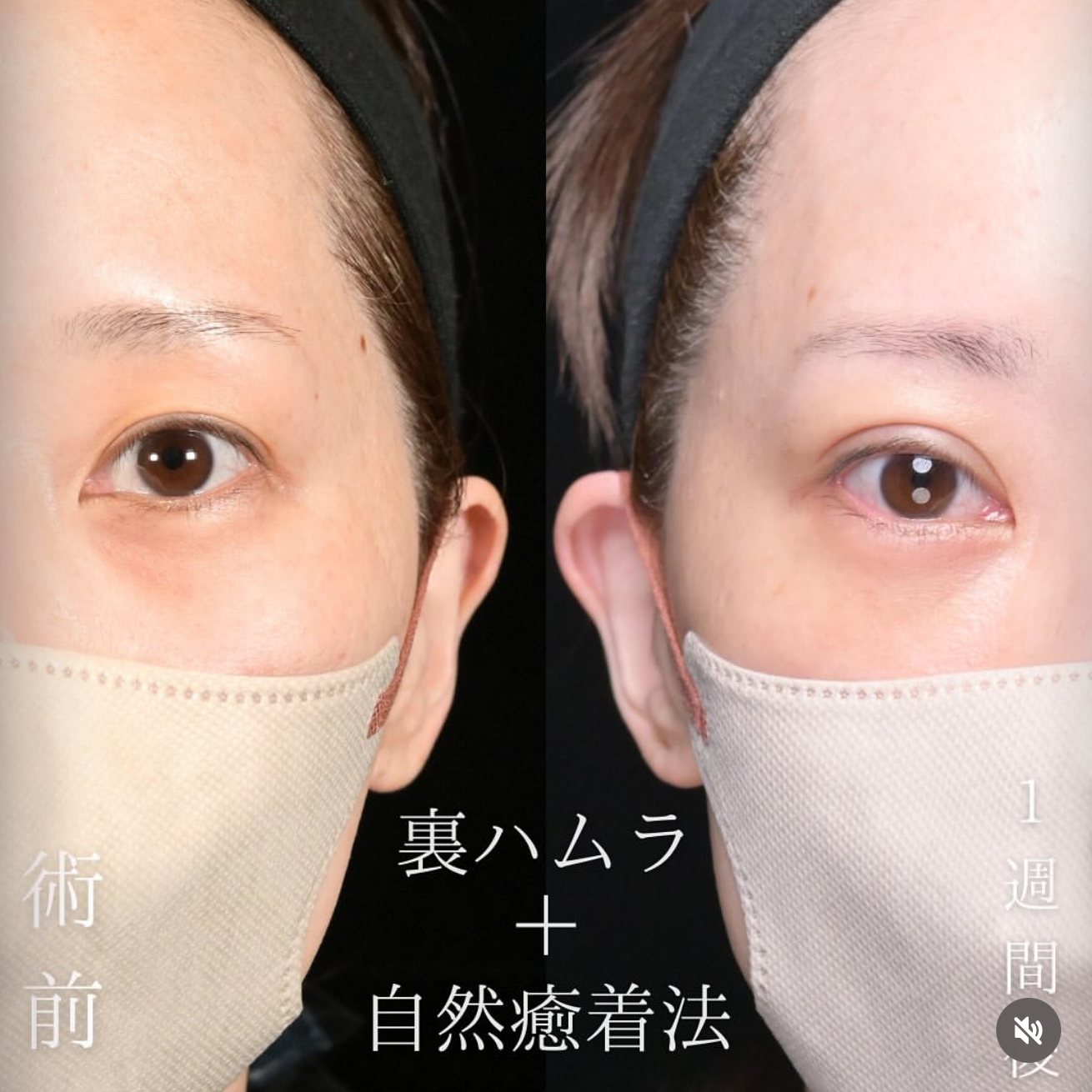 楠本医師による裏ハムラ、埋没法(自然癒着)の術前/術後1週間
