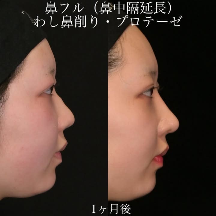 上木原医師による鼻整形の術前/術後1ヶ月 施術後 